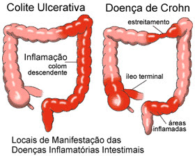 colite-intestino
